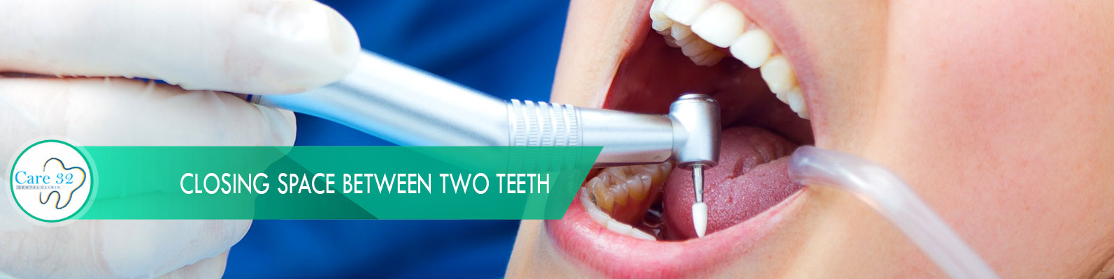 Composite-Tooth-Filling-Andheri-Mumbai