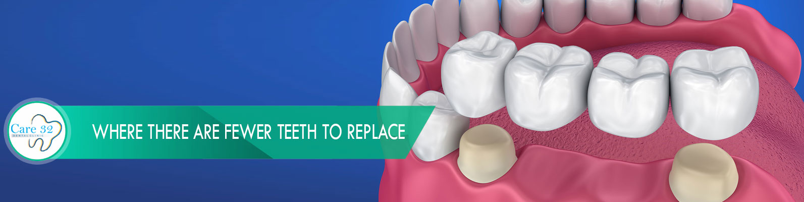 Dental-Bridge-Treatment-Mumbai-Andheri