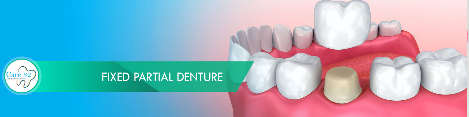 Dental-Crwons-Andheri-Mumbai