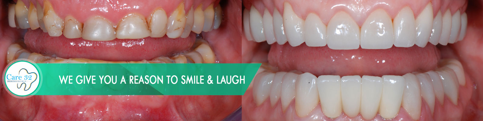 Full-Mouth-Reconstruction-in-Mumbai-Andheri-East