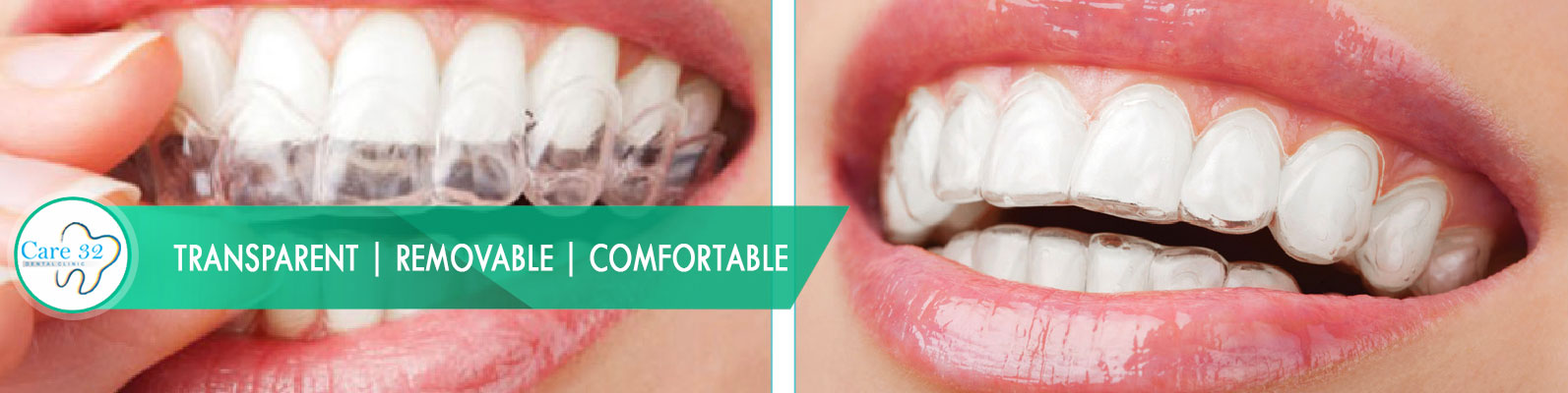 Invisible-Dental-Braces-in-Mumbai-Andheri-East