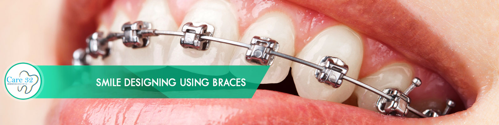 Orthodontics-Dental-Treatment-Mumbai-Andheri